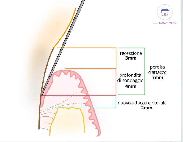 Schema della guarigione parodontale