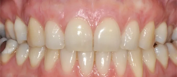 Chirurgia muco-gengivale post-operatoria