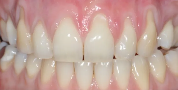 Chirurgia muco-gengivale pre-operatoria