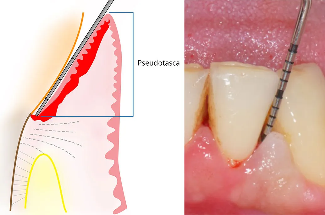 Pseudotasca parodontale