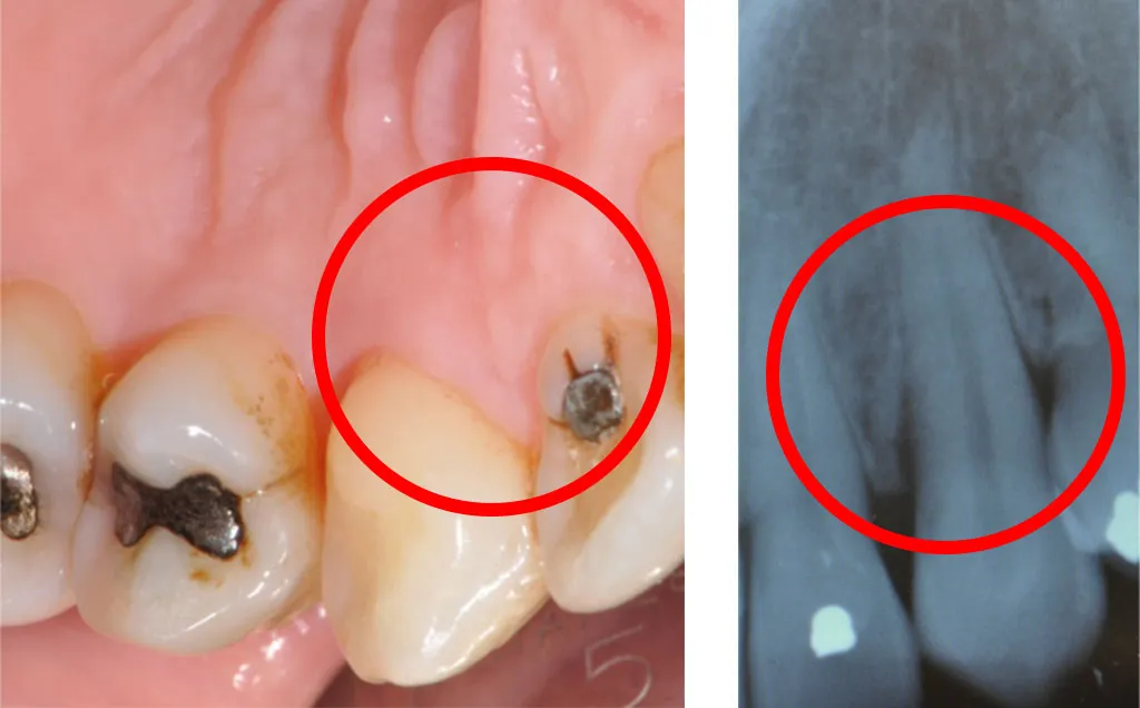 Chirurgia rigenerativa post-operatoria