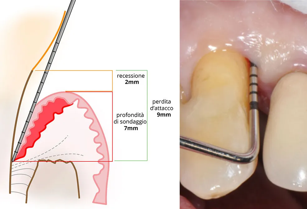 Tasca parodontale con recessione