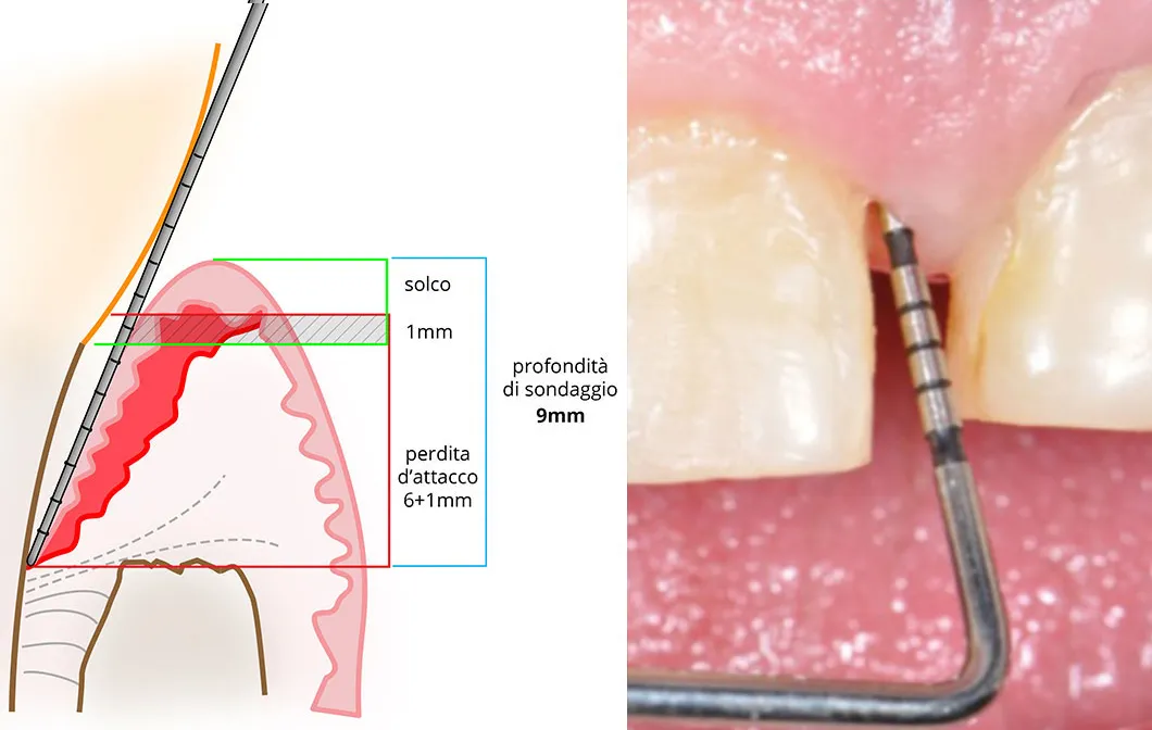 Tasca parodontale senza recessione